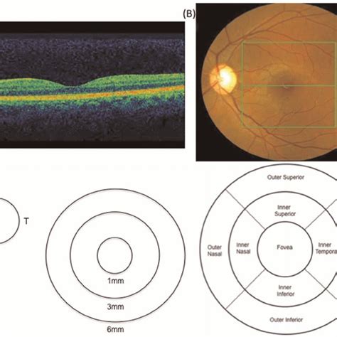 macular edema retinal thickness measurement|right eye macular thickness.